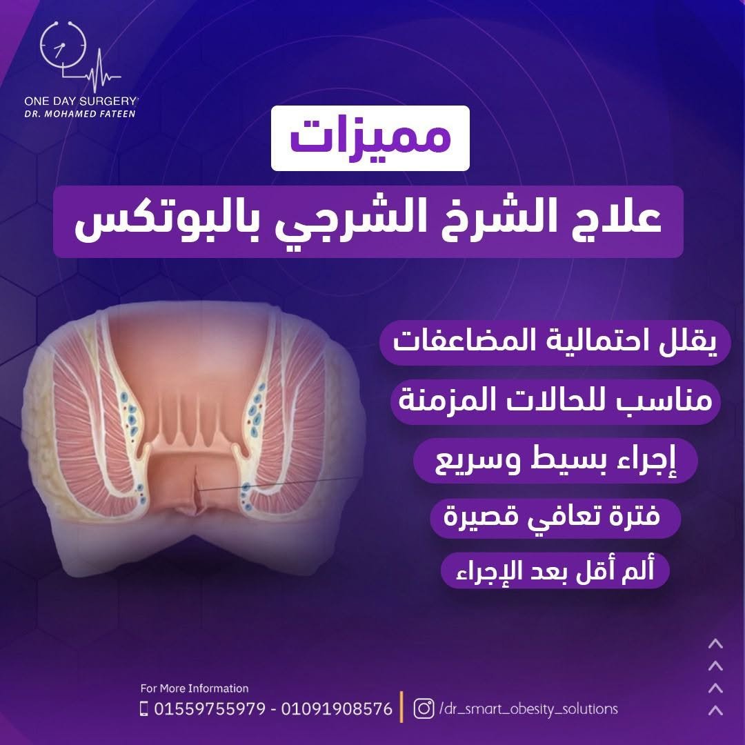 مميزات علاج الشرخ الشرجي بالبوتكس